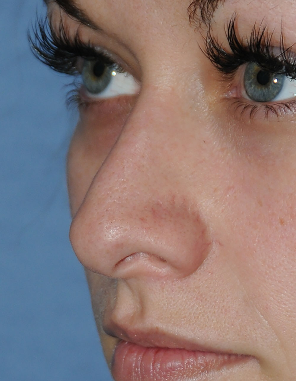 Rhinoplasty for a Bulbous / Plunging / Hook / Hanging Nasal Tip, Wide Middle Third, and Relatively Prominent Nasal Bridge Before Left Oblique Close Up View Rhinoplasty for a Bulbous / Plunging / Hook / Hanging Nasal Tip, Wide Middle Third, and Relatively Prominent Nasal Bridge Before Left Oblique Close Up View
