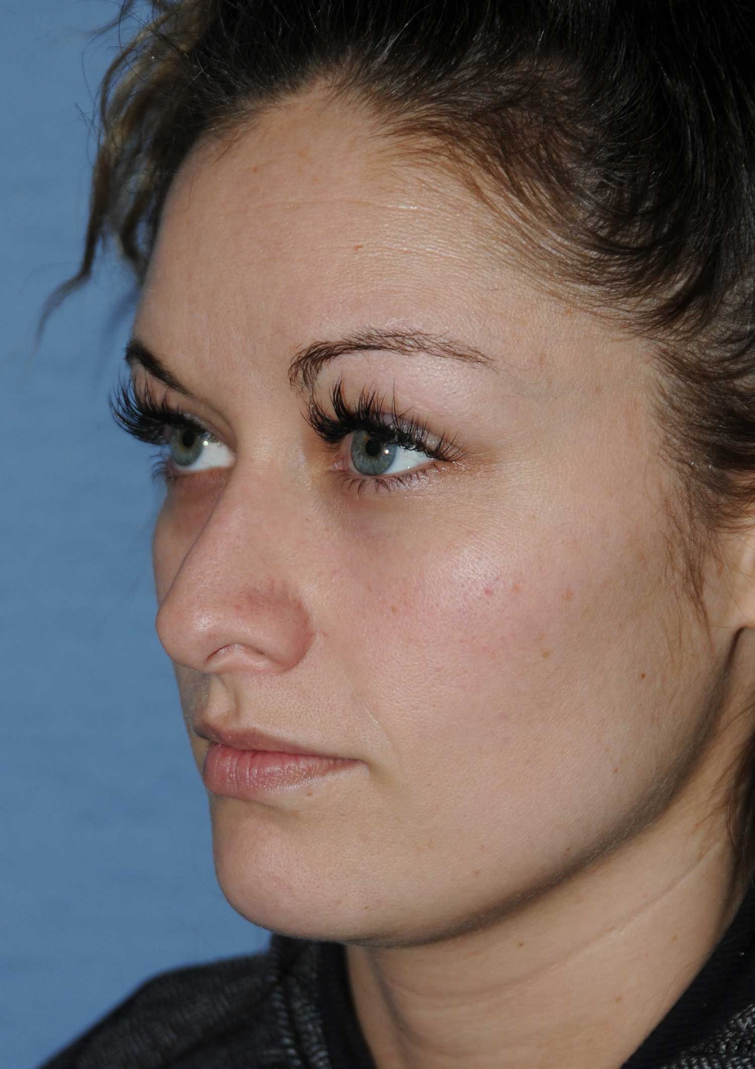Rhinoplasty for a Bulbous / Plunging / Hook / Hanging Nasal Tip, Wide Middle Third, and Relatively Prominent Nasal Bridge Before Left Oblique View Rhinoplasty for a Bulbous / Plunging / Hook / Hanging Nasal Tip, Wide Middle Third, and Relatively Prominent Nasal Bridge Before Left Oblique View