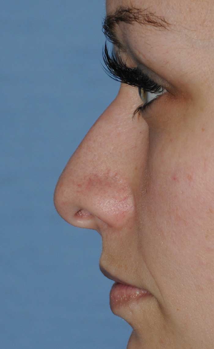 Rhinoplasty for a Bulbous / Plunging / Hook / Hanging Nasal Tip, Wide Middle Third, and Relatively Prominent Nasal Bridge Before Left Profile Close Up View Rhinoplasty for a Bulbous / Plunging / Hook / Hanging Nasal Tip, Wide Middle Third, and Relatively Prominent Nasal Bridge Before Left Profile Close Up View
