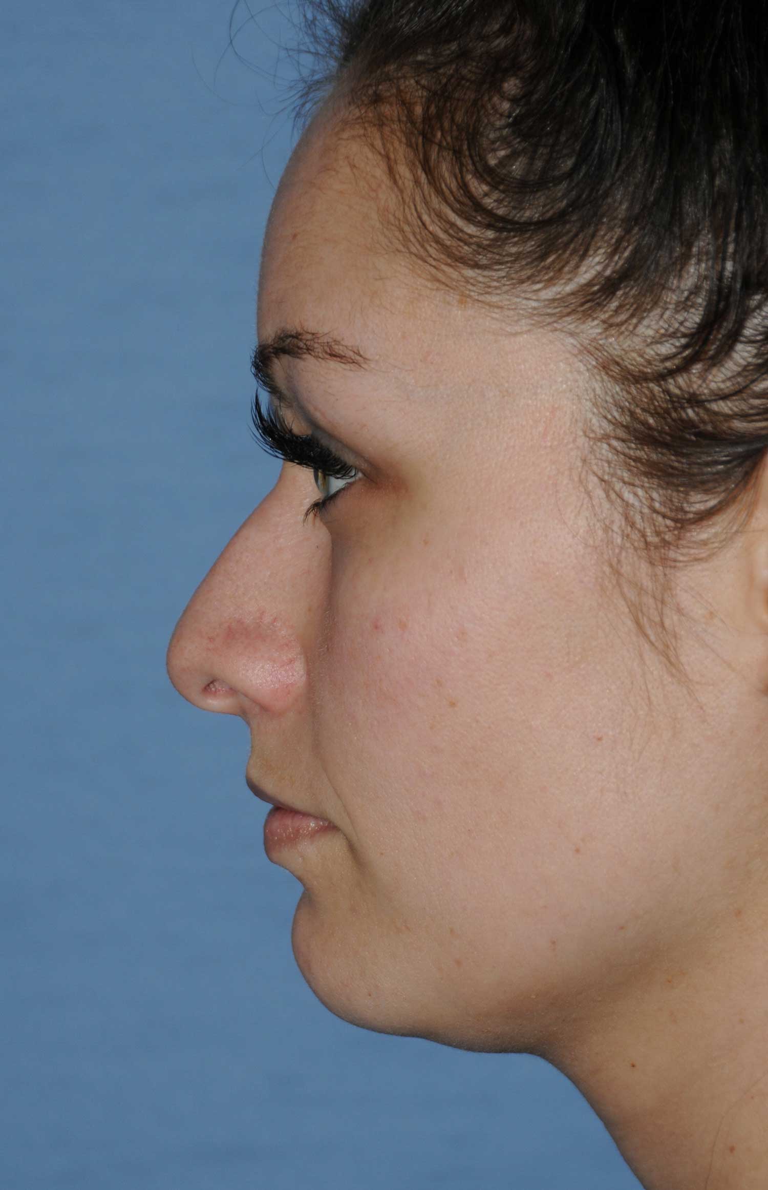 Rhinoplasty for a Bulbous / Plunging / Hook / Hanging Nasal Tip, Wide Middle Third, and Relatively Prominent Nasal Bridge Before Left Profile View Rhinoplasty for a Bulbous / Plunging / Hook / Hanging Nasal Tip, Wide Middle Third, and Relatively Prominent Nasal Bridge Before Left Profile View