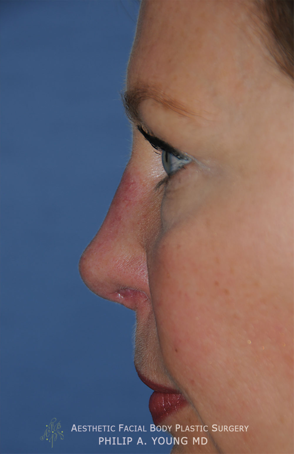 After Revision Rhinoplasty for Crooked Tip, Crooked Nasal Bridge, Nose Bridge Dorsal Irregularities, Hook & Droopy Nasal Tip, Retracted Alae Nostrils Left Side Close Up View.