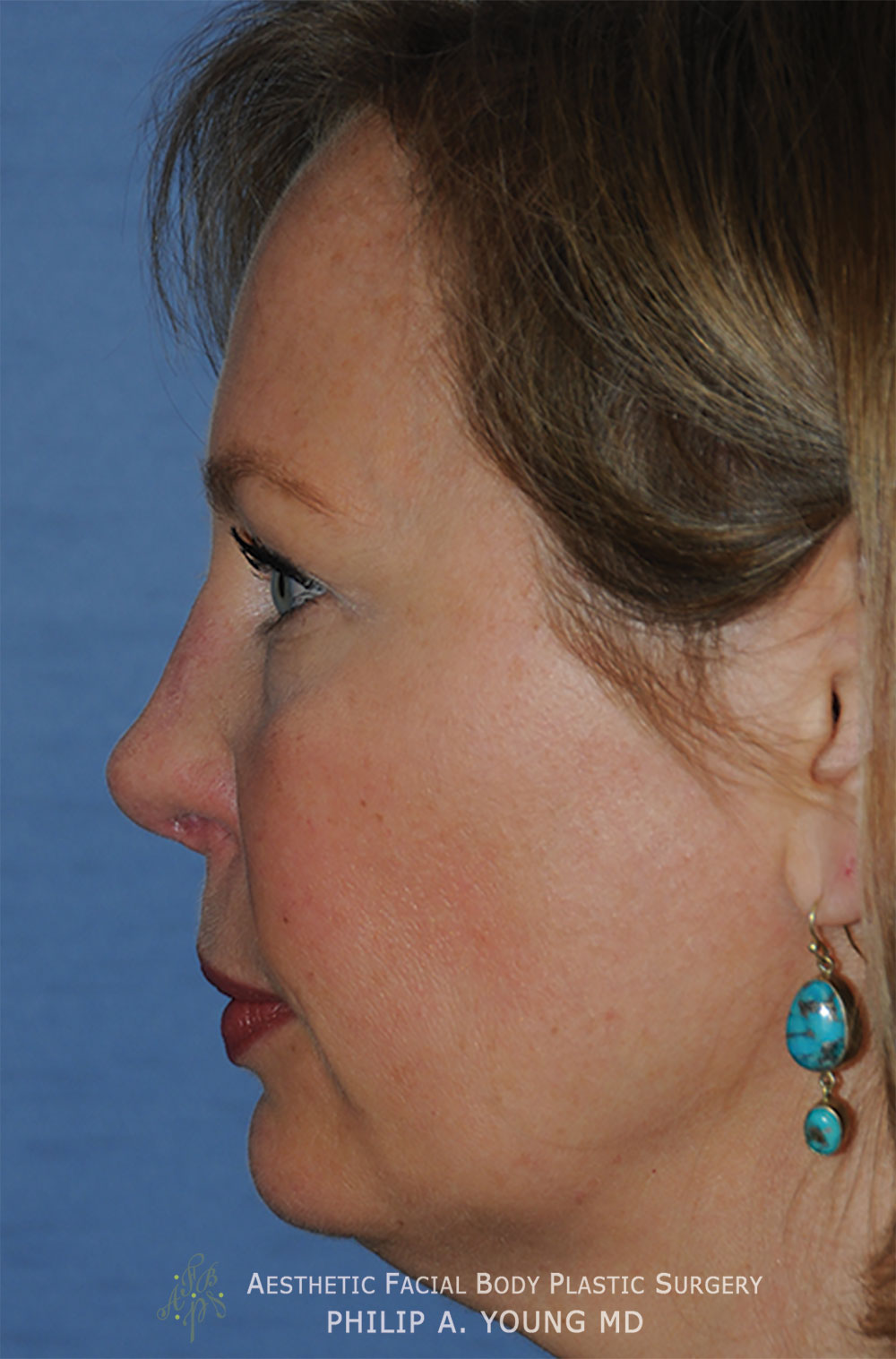 After Revision Rhinoplasty for Crooked Tip, Crooked Nasal Bridge, Nose Bridge Dorsal Irregularities, Hook & Droopy Nasal Tip, Retracted Alae Nostrils Left Side View.