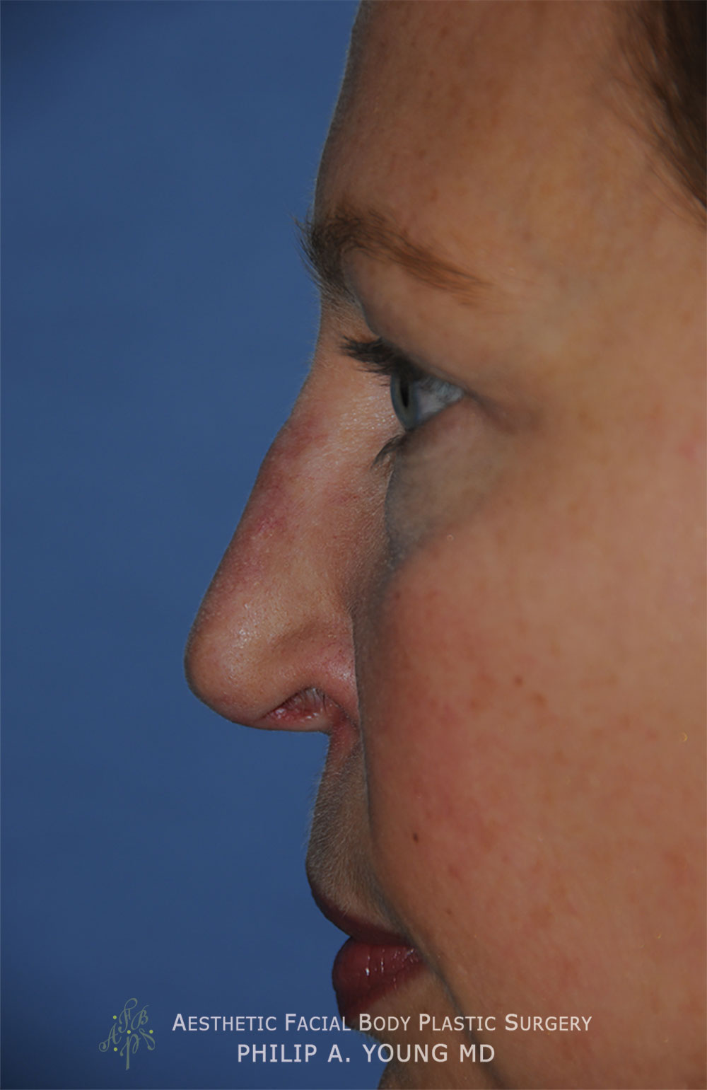 Before Revision Rhinoplasty for Crooked Tip, Crooked Nasal Bridge, Nose Bridge Dorsal Irregularities, Hook & Droopy Nasal Tip, Retracted Alae Nostrils Left Side Close Up View.
