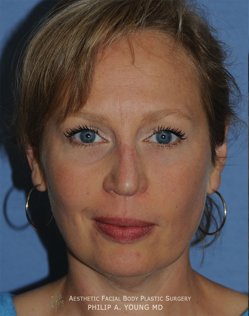 Before Revision Rhinoplasty for Crooked Tip, Crooked Nasal Bridge, Nose Bridge Dorsal Irregularities, Hook & Droopy Nasal Tip, Retracted Alae Nostrils.