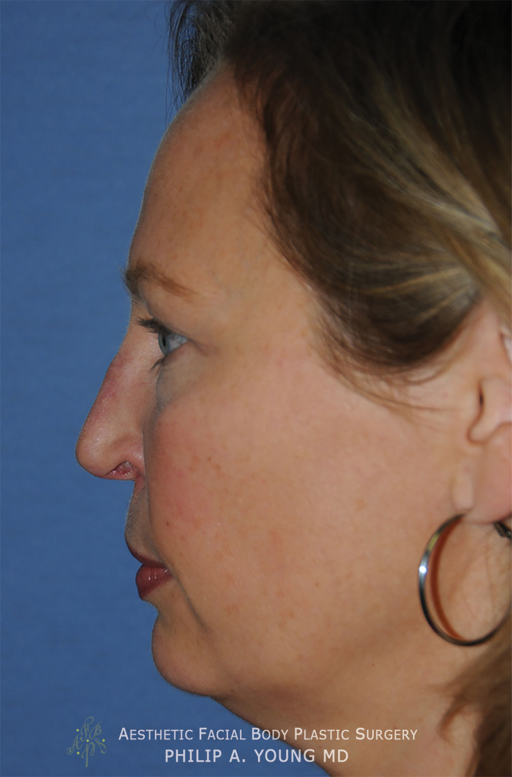 Before Revision Rhinoplasty for Crooked Tip, Crooked Nasal Bridge, Nose Bridge Dorsal Irregularities, Hook & Droopy Nasal Tip, Retracted Alae Nostrils Left Side View.