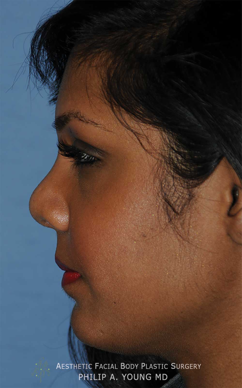 After Reconstructive Rhinoplasty for this nose with a Bulbous Nasal Tip, Crooked Nasal Bridge, & Retracted Columella that was shortened traumatically After Reconstructive Rhinoplasty for this nose with a Bulbous Nasal Tip, Crooked Nasal Bridge, & Retracted Columella that was shortened traumatically