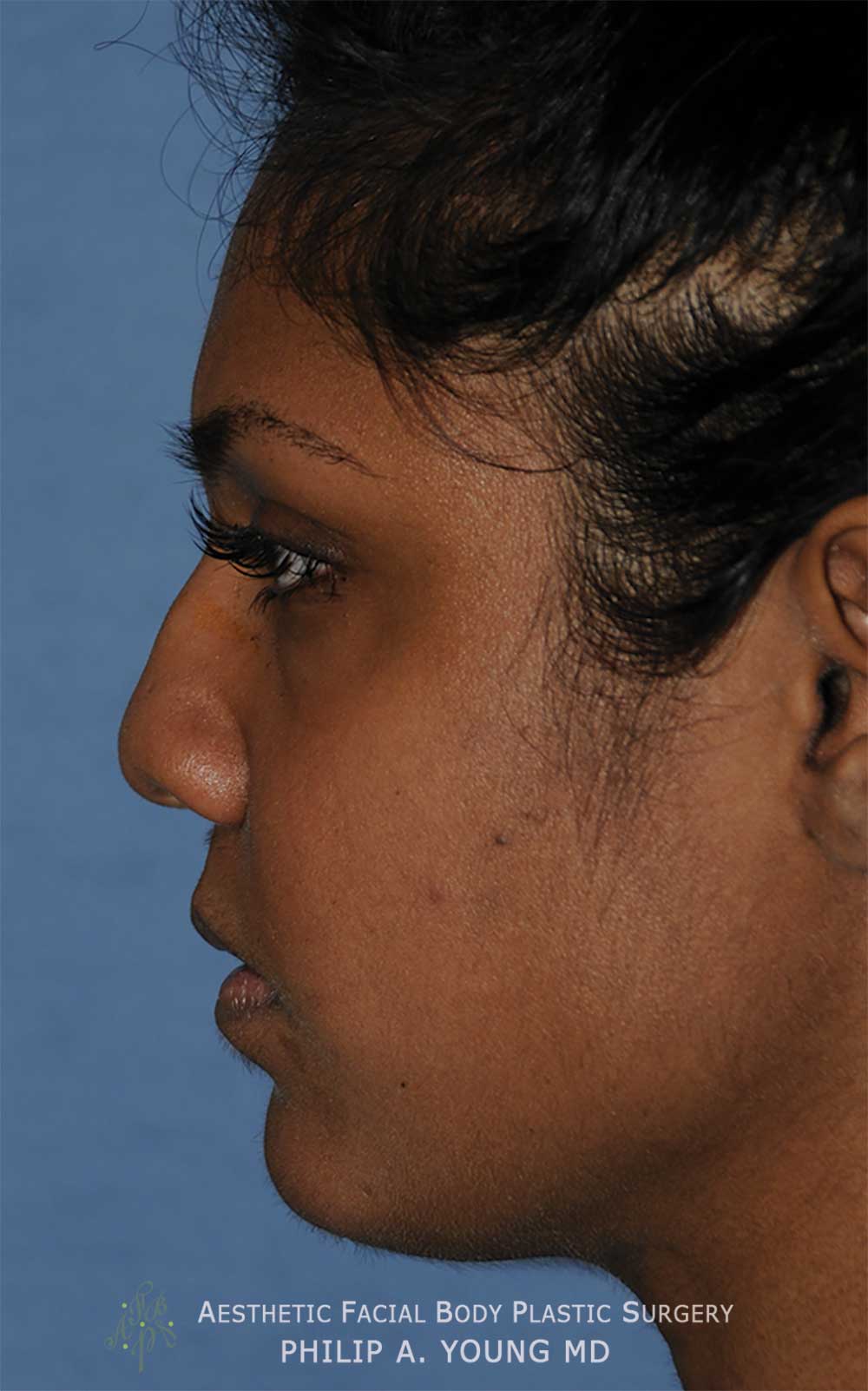 Before Reconstructive Rhinoplasty for this nose with a Bulbous Nasal Tip, Crooked Nasal Bridge, & Retracted Columella that was shortened traumatically Before Reconstructive Rhinoplasty for this nose with a Bulbous Nasal Tip, Crooked Nasal Bridge, & Retracted Columella that was shortened traumatically