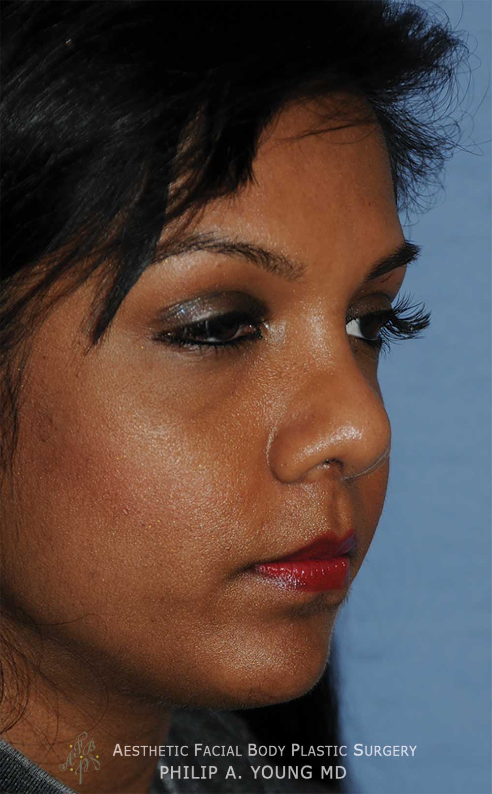After Reconstructive Rhinoplasty for this nose with a Bulbous Nasal Tip, Crooked Nasal Bridge, & Retracted Columella that was shortened traumatically Right Oblique View After Reconstructive Rhinoplasty for this nose with a Bulbous Nasal Tip, Crooked Nasal Bridge, & Retracted Columella that was shortened traumatically Right Oblique View
