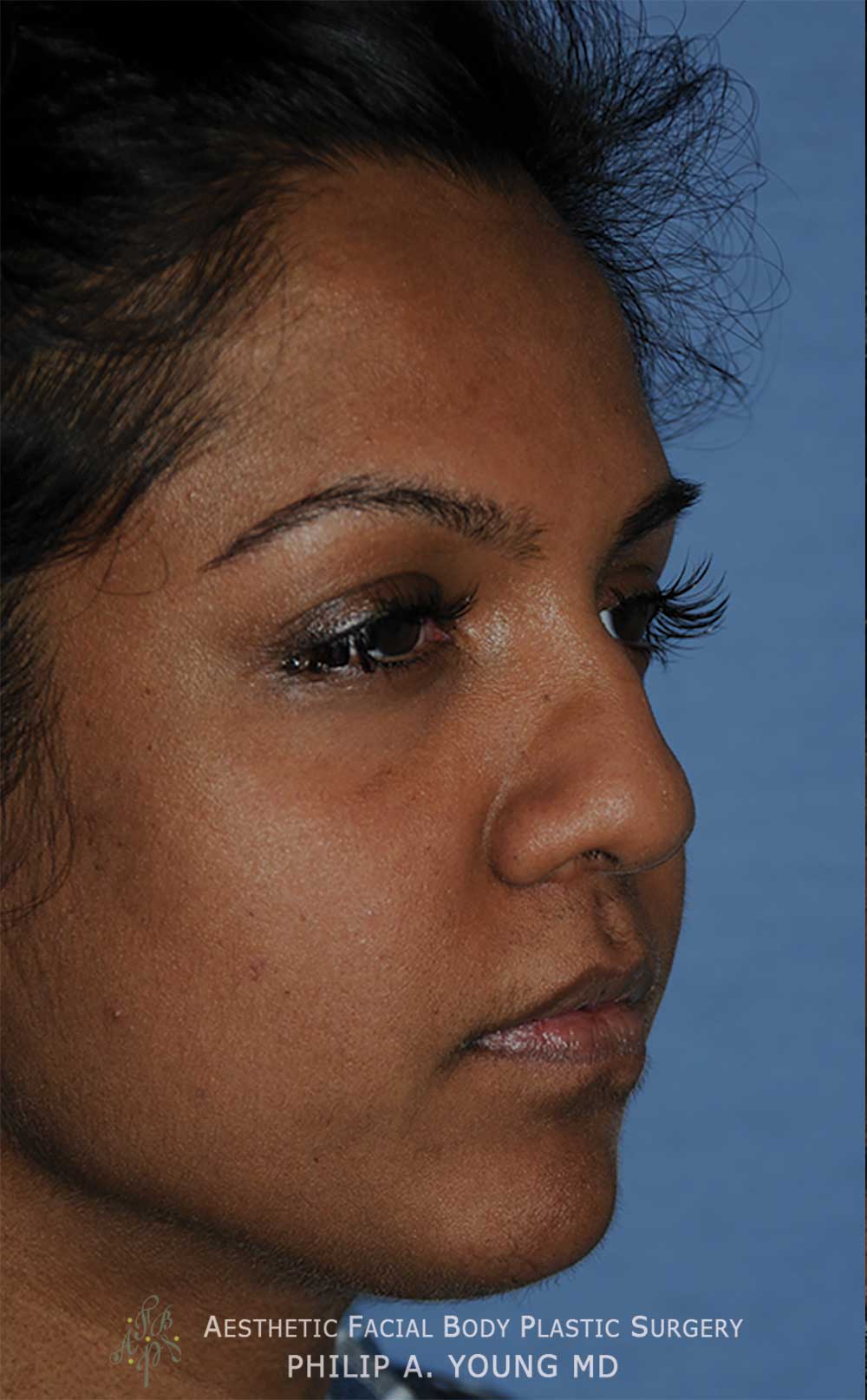 Before Reconstructive Rhinoplasty for this nose with a Bulbous Nasal Tip, Crooked Nasal Bridge, & Retracted Columella that was shortened traumatically Right Oblique View Before Reconstructive Rhinoplasty for this nose with a Bulbous Nasal Tip, Crooked Nasal Bridge, & Retracted Columella that was shortened traumatically Right Oblique View