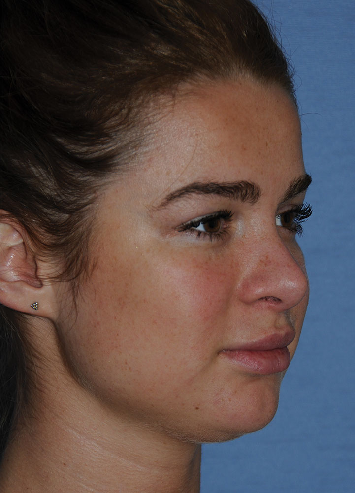 After Transgender Feminization Rhinoplasty Procedure Side Profile After Transgender Feminization Rhinoplasty Procedure Side Profile