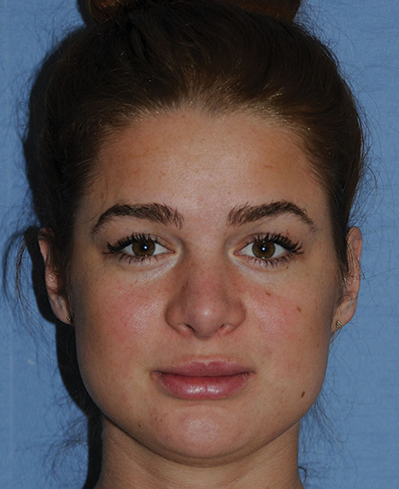 After Transgender Feminization Rhinoplasty Procedure Side Profile After Transgender Feminization Rhinoplasty Procedure Side Profile