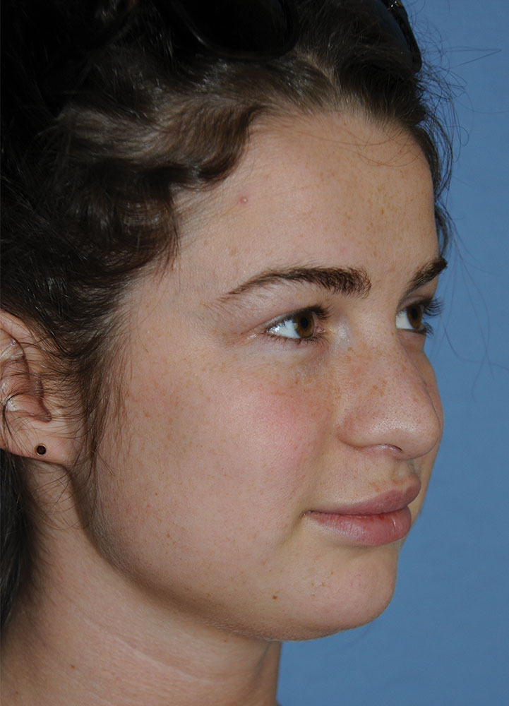Before Transgender Feminization Rhinoplasty Procedure Side Profile Before Transgender Feminization Rhinoplasty Procedure Side Profile