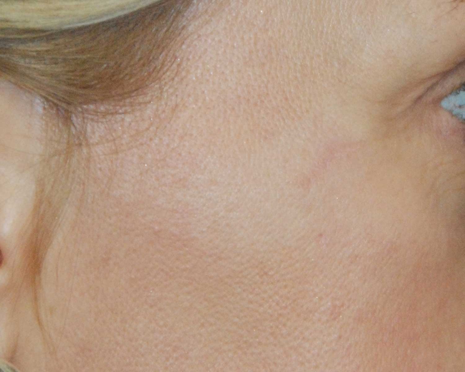 Right Cheek Mole Skin Lesion After Excision for the top mole and Co2 Laser Removal for the bottom mole Right Cheek Mole Skin Lesion After Excision for the top mole and Co2 Laser Removal for the bottom mole