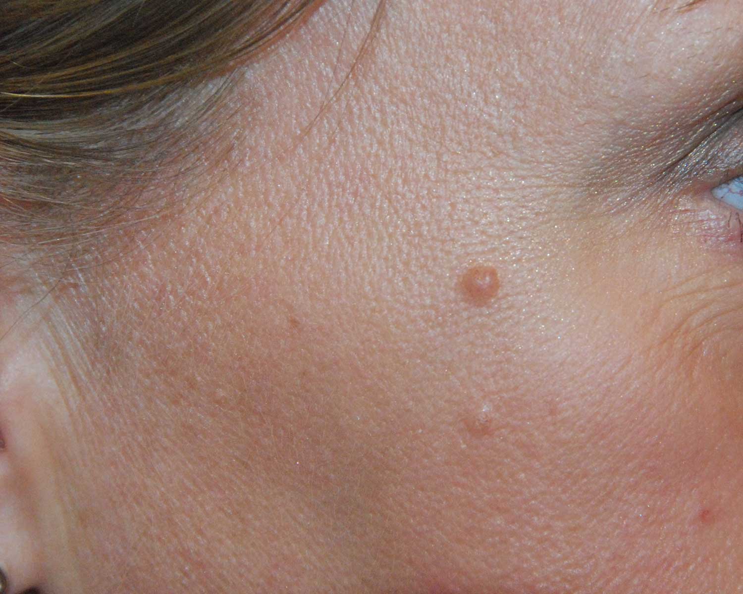 Right Cheek Mole Skin Lesion Before Excision for the top mole and Co2 Laser Removal for the bottom mole Right Cheek Mole Skin Lesion Before Excision for the top mole and Co2 Laser Removal for the bottom mole