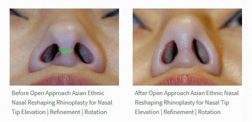 Open Approach to Rhinoplasty Worms Eye View Open Approach to Rhinoplasty Worms Eye View