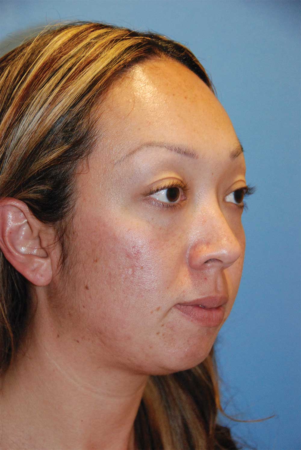 Before Chin Implant for a Retruded, Small Chin and Filler Under the Eyelid and in the Cheek Region Oblique View<u><strong>for Lower Eyelid Hollowing, Bags & for a Lack of Cheek Projection</strong></u>