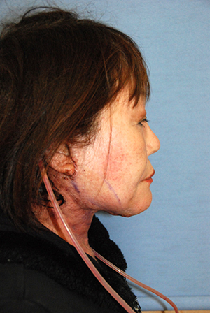 Neck lift recovery bellevue seattle