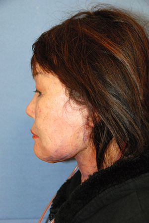 Neck lift recovery bellevue seattle