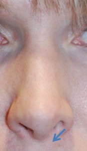 Revision Rhinoplasty 15 Revision Rhinoplasty 15