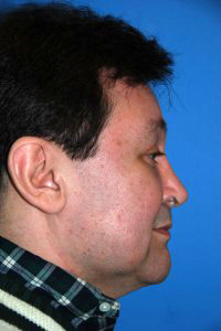 Right Lateral