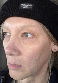 FTM+Genital+Surgery+Photos transgender surgery female to male pictures bottom Transgender Surgery