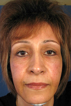 brow lift incision less face lift front after brow lift incision less face lift front after