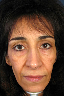 brow lift incision less face lift front before brow lift incision less face lift front before