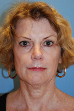 Cheek lift youngvitalizer after treatment in Bellevue Cheek lift youngvitalizer after treatment in Bellevue