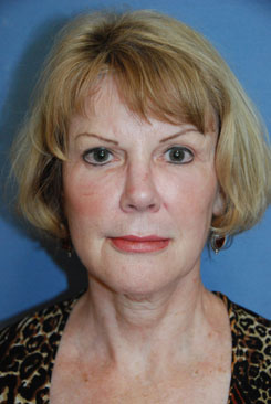Cheek lift youngvitalizer before treatment in Bellevue Cheek lift youngvitalizer before treatment in Bellevue
