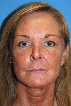 Cheek plastic surgery after treatment in Bellevue Cheek plastic surgery after treatment in Bellevue