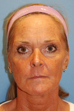 Cheek plastic surgery before treatment in Bellevue Cheek plastic surgery before treatment in Bellevue