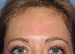Chemical Peel After Chemical Peel After