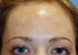 Chemical Peel Before Chemical Peel Before