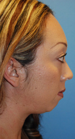 Before Silicone Chin Implant Lateral View For Weak Retrusive Chin Before Silicone Chin Implant Lateral View For Weak Retrusive Chin