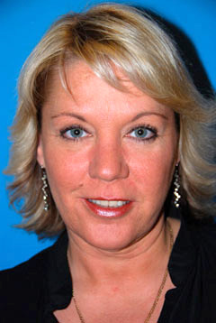 Eye Lift Blepharoplasty After Eye Lift Blepharoplasty After