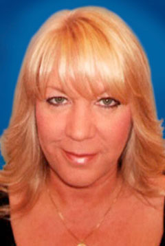 Eye Lift Blepharoplasty Before Eye Lift Blepharoplasty Before