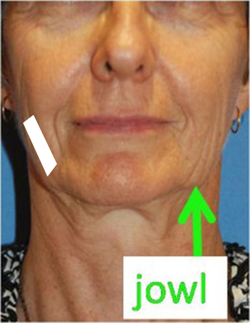 Facelift swelling