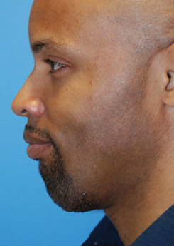 After Chin augmentation using a custom size silicone implant After Chin augmentation using a custom size silicone implant