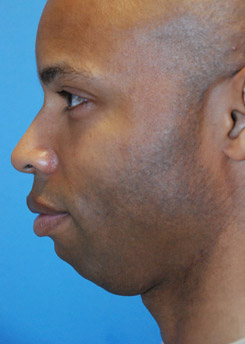 Before Chin augmentation using a custom size silicone implant Before Chin augmentation using a custom size silicone implant