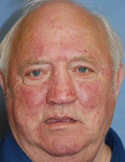 Facial Reconstruction for Rhinophyma and Tumor After Facial Reconstruction for Rhinophyma and Tumor After