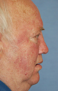Facial Reconstruction for Rhinophyma Nasal After Facial Reconstruction for Rhinophyma Nasal After
