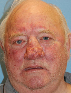 Facial Reconstruction for Rhinophyma and Tumor Before Facial Reconstruction for Rhinophyma and Tumor Before