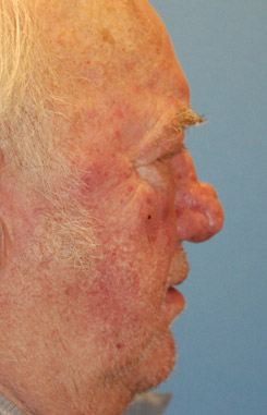 Facial Reconstruction for Rhinophyma Nasal Before Facial Reconstruction for Rhinophyma Nasal Before