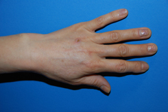 Before Fat Grafting | Augmentation | Injections to Rejuvenate the Hands Before Fat Grafting | Augmentation | Injections to Rejuvenate the Hands
