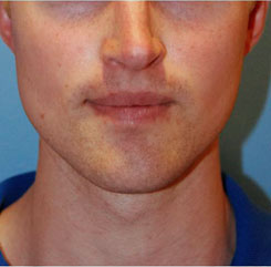 Jaw Implants After