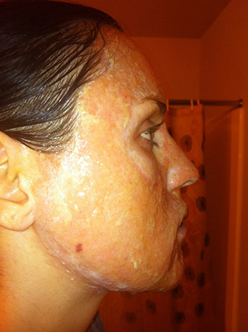 laser resurfacing photo 3 laser resurfacing photo bellevue seattle
