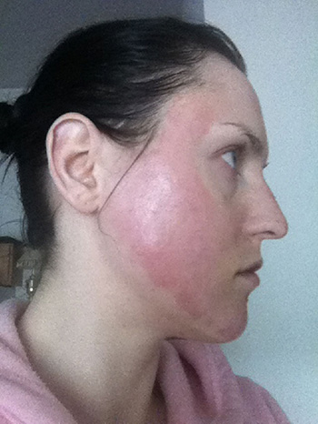 laser resurfacing photo 13 laser resurfacing photo bellevue seattle