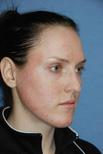 laser resurfacing photo 17 laser resurfacing photo bellevue seattle