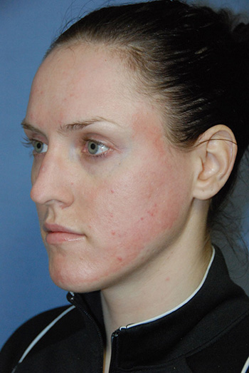 laser resurfacing photo 16 laser resurfacing photo bellevue seattle