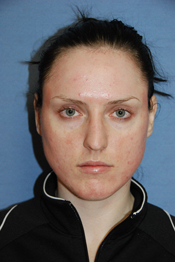 laser resurfacing photo 15 laser resurfacing photo bellevue seattle